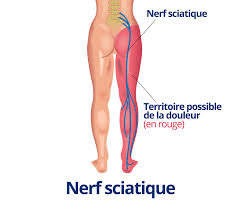 Epingle Sur Sciatalgie