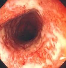 Image result for Ulcerative Colitis