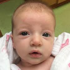 Image result for Cradle Cap