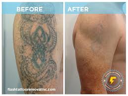 Plus, a topical numbing agent will also be used on your skin, to manage the pain even more. How Does Laser Tattoo Removal Work In Calgary Flash Tattoo Removal Inc