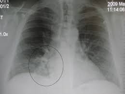 Pneumonia is a common lung infection caused by bacteria or viruses that can lead to mild to severe illness. Occult Pneumonia Wikipedia