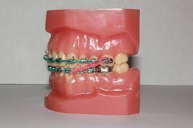 I have to wear triangle elastics for my braces but only on one side.the other side has the bands going from the canine to the other will this work ? Elastics Orthodontic Specialists Llc St George Ut