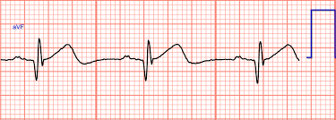 Image result for Q Wave