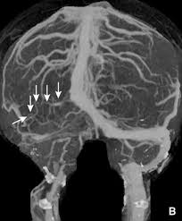 Implica una falta de circulación (aporte de riego sanguíneo) que daña los órganos, como por ejemplo: Trombosis Venosas Cerebrales Sciencedirect