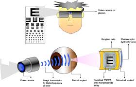 A file that is sent with an email. Retinal Prostheses In Degenerative Retinal Diseases Sciencedirect