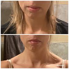 Best Invisalign® Smile Corrections In Plymouth, Mn