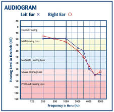 How To Read An Audiogram And Determine Degrees Of Hearing Loss
