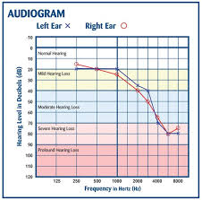 how to read an audiogram and determine degrees of hearing loss