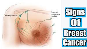 Because of this, mammograms are relatively less effective in women less than 35 years age. How To Know If You Have Breast Cancer Signs Of Breast Cancer Youtube