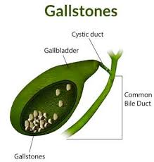 Gallstones are hard pieces of material that can form in your gallbladder. Gallbladder Stones Removal Without Surgery In Homeopathy Homeopathic Doctor