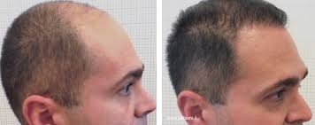 L'intervento di autotrapianto dei capelli viene eseguito in anestesia locale accompagnata da sedazione. Costi Del Trapianto Capelli Clinica Pallaoro