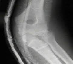 The management of displaced medial humeral epicondyle fractures in children remains controversial. Medial Epicondyle Frx Of The Humerus Wheeless Textbook Of Orthopaedics