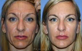 Botox Dysport Xeomin Photos Botox Injections Botox Nose Job