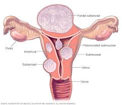 Medical diagram of the uterus showing types and locations of uterine fibroids