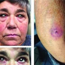 a-c. The patient presented right-sided facial swelling, ipsilateral...