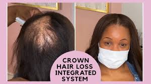 If you have crown thinning hair, you may also be deficient in key nutrients that help you grow and maintain healthy hair. System For Crown Hair Loss No Wig No Braided Weave Youtube