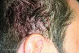 I write this blog on behalf of and in conjunction with jennifer. Hair Loss Who Gets And Causes