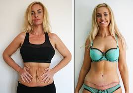 And now the big brother star has shown off her impressive weight loss on instagram by posting a before and after picture. Weight Loss Josie Gibson Reveals Tummy Tuck Before And After Pictures Express Co Uk