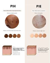 Image result for Mild PIH Management