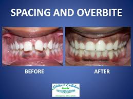 A dental implant is a surgically placed. Braces Before And After Spacing And Overbite Invisalign Braces Braces Before And After Orthodontist