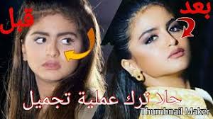 وشغل في الطريق إلى النصر مع الألم والدموع. Ø­Ù„Ø§ ØªØ±Ùƒ Ø¹Ù…Ù„ÙŠØ© ØªØ¬Ù…ÙŠÙ„ Hala Turk Nose Surgery Youtube