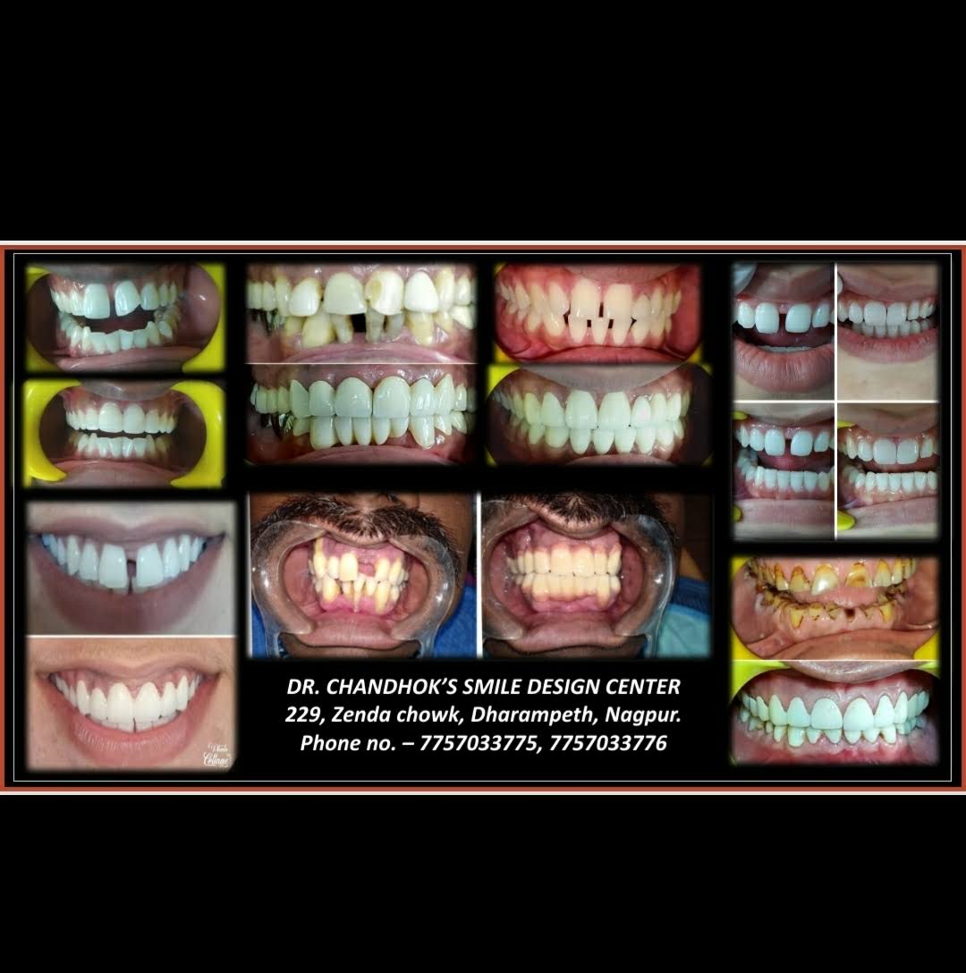 Full Mouth Rehablitation product image