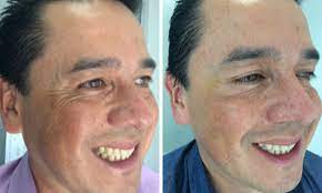 El botox ® es aplicado directamente en el músculo responsable de la formación de la línea o arruga de expresión. Botox Bogota Eliminar Arrugas Precios Dra Tatiana Leal