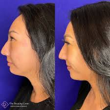 𝑼𝒏𝒍𝒐𝒄𝒌 𝒀𝒐𝒖𝒓 𝑻𝒓𝒖𝒆 𝑩𝒆𝒂𝒖𝒕𝒚✨ • 2 syringes of Restylane Lyft  used to volumize the Cheeks, 1ml of Restylane Contour to help restore mid  face volume, 1 syringe of Restylane Lyft to decrease