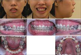 The best way to grow comfortable with smiling while wearing braces is to practice. Aggravation Of Gummy Smile By Straight Wire Mechanics And Its Management With Or Without Orthognathic Surgery Up To 10 Year Follow Up Apos Trends In Orthodontics