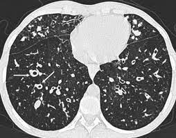 Pda, viral infection, foreign body. Computed Tomography And Cystic Fibrosis Promises And Problems Thorax