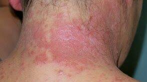 Image result for dermatitis contacta allergica