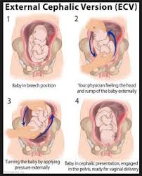 Download lagu doa bayi songsang ke normal mp3 gratis, download mp3 doa bayi. Tips Bayi Songsang Kaedah Ecv