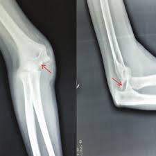 In adults, this medial prominence is completely bony, but in children, the medial epicondyle is composed of an ossification center of cartilage and bone. Pdf Treatment Of Medial Humeral Epicondyle Fractures In Children Using Absorbable Self Reinforced Polylactide Pins