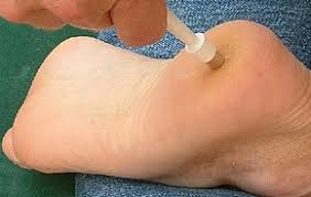 How do shave biopsy wounds heal? Skin Biopsy Wikipedia