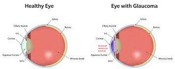 Glaucoma Boston Glaucoma Treatment Boston Neec