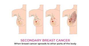 Metastatic breast cancer is stage iv cancer, which has spread to other parts of the body. Secondary Breast Cancer Poorti A Product Of Aarna Biomedical
