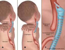 Maybe you would like to learn more about one of these? Esophageal Atresia Symptoms Surgery Children S Minnesota