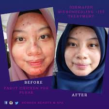 Ini kali pertama tau saya kena. Schada Beauty Spa Rawatan Untuk Menghilangkan Parut Chicken Pox Di Wajah