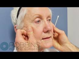 Neck Lift with Dr. Ronald Gilmer
