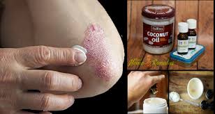 So how can you use apple cider vinegar for eczema? How To Use Coconut Oil For Eczema