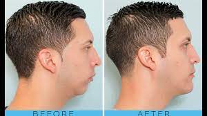 Does Chewing Gum Strengthen Your Jaw Youtube