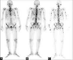27.04.2008 · bone scans in diagnosis of prostate cancer. A C A 76 Year Old Man Presented With Metastatic Prostate Carcinoma Download Scientific Diagram