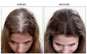 hairvox vorher nachher erblich bedingter haarausfall haare vorher nachher kokosol haare vorher nachher