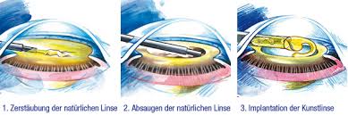 Erst nach der operation des grauen stars am ersten auge, fällt dem betroffenen der große farbunterschied zum noch nicht operierten auge auf: Die Operation Des Grauen Star
