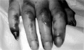 The two common presentations of meningococcal infection are meningococcal meningitis (infection of the membranes that surround the brain and spinal cord) and meningococcemia (infection of the bloodstream). Purpura Fulminans In Sepsis The American Journal Of The Medical Sciences