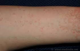 Image result for scabies human children