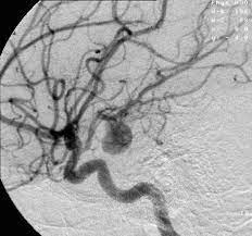 El objetivo del tratamiento es controlar los síntomas y prevenir futuros sangrados. Aneurysm Wikipedia