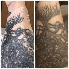We encourage all laser tattoo removal. Tattoo Removal Take It Off
