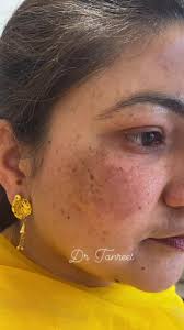 Dr Tanreet's Skin Hair & Laser Center in Amritsar Colony,Amritsar