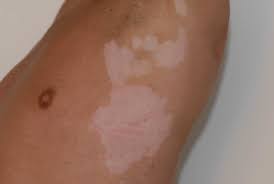 So kann die haut darunter kein farbpigment (melanin) mehr bilden. Was Ist Vitiligo Weissfleckenkrankheit Und Wie Wird Es Behandelt